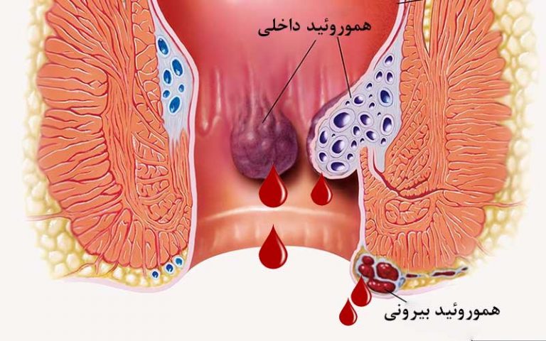 بواسیر خونی