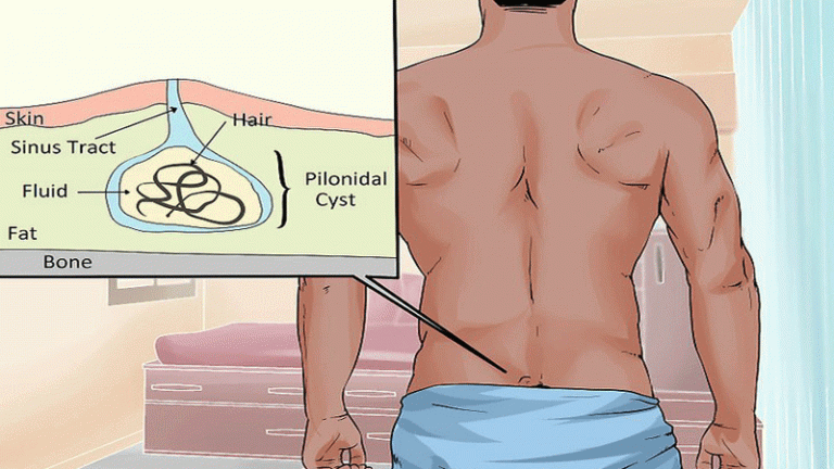 عوارض عمل نکردن کیست مویی