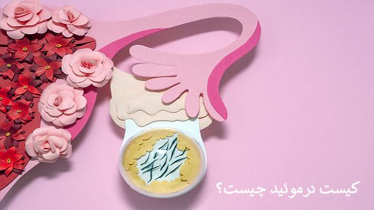 کیست درموئید