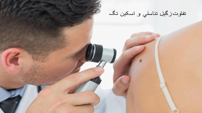 تفاوت اسکین تگ ها و زگیل تناسلی