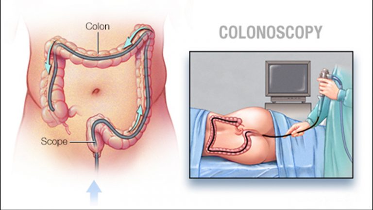 کولونوسکوپی