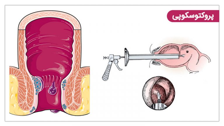 نحوه معاینه با روش پروکتوسکوپی