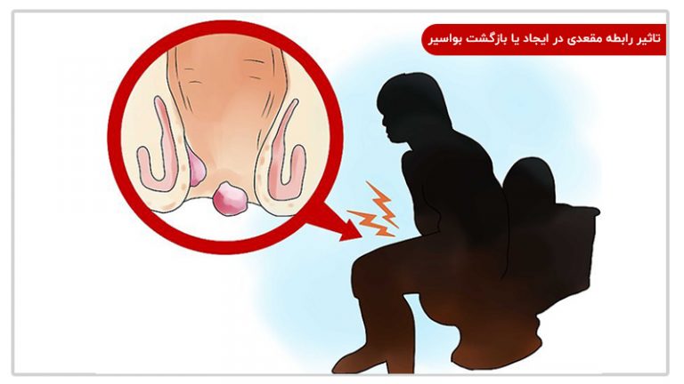 تاثیر رابطه مقعدی بر بواسیر یا هموروئید
