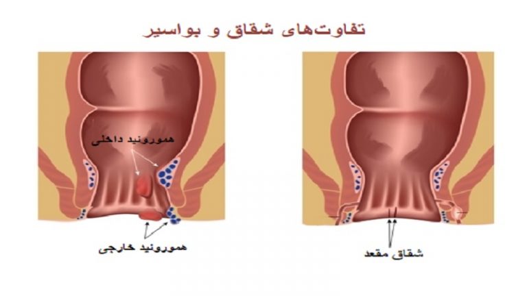 تفاوت شقاق و بواسیر