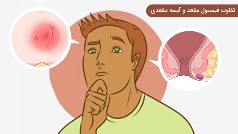تفاوت فیستول مقعد و آبسه مقعدی