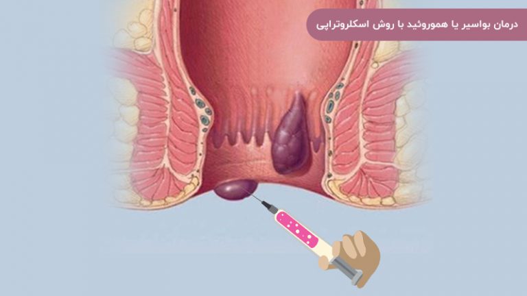 درمان بواسیر یا هموروئید با روش اسکلروتراپی