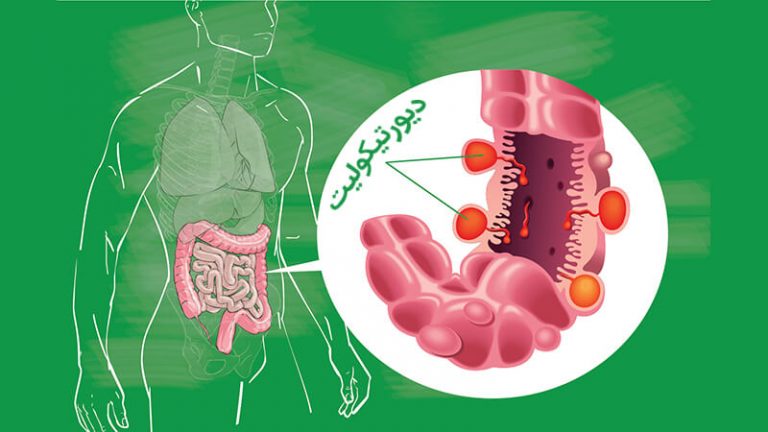 بیماری دیورتیکولیت