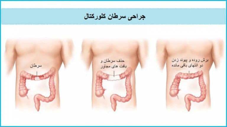 درمان سرطان کلورکتال