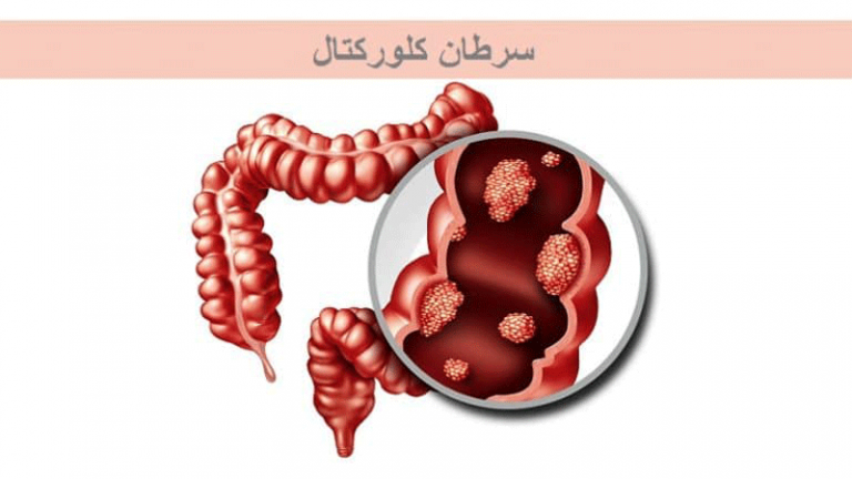 علائم سرطان روده بزرگ