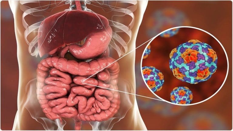 گاستروانتریت ویروسی