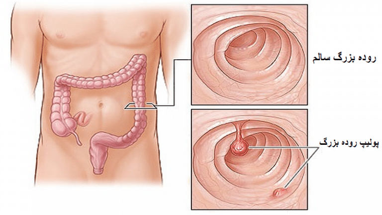 پولیپ روده بزرگ