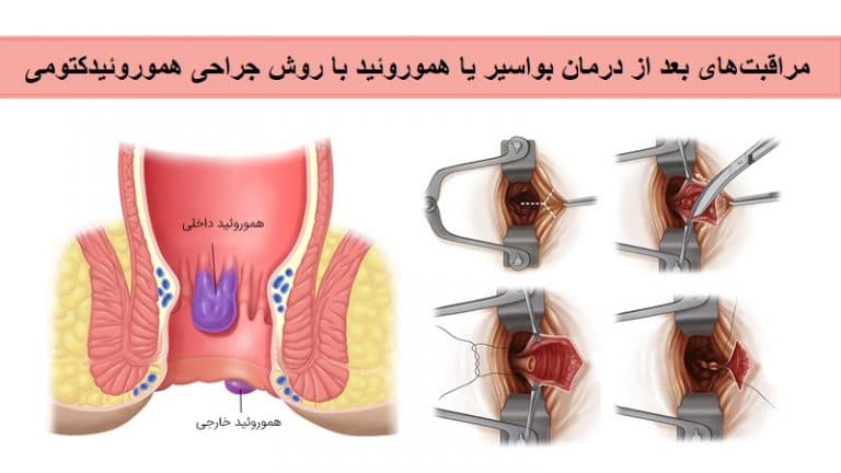 مراقبت های بعد از درمان بواسیر