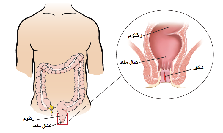 عکس شقاق مقعدی برای تشخیص و درمان قطعی بیماری