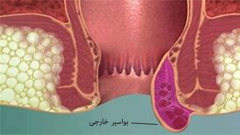 درمان بواسیر (هموروئید) خارجی با لیزر و جراحی