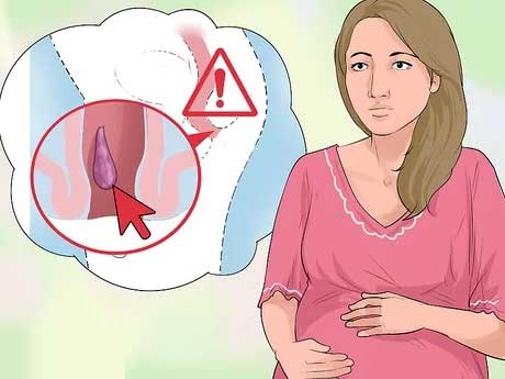 بواسیر یا هموروئید خونی در دوران بارداری