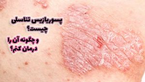 عکس پسوریازیس تناسلی در سایت ایران کلینیک