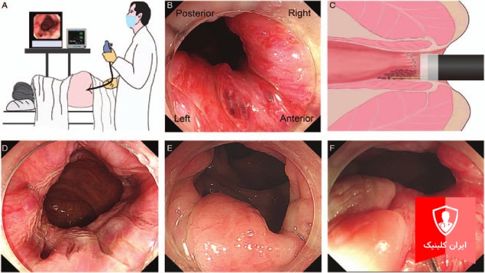 عکس انواع هموروئید داخلی