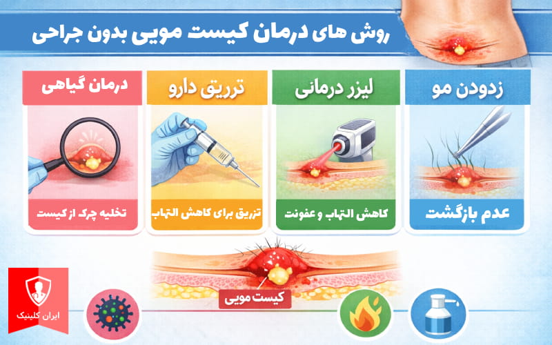 تصویر روشهای درمان کیست مویی بدون جراحی