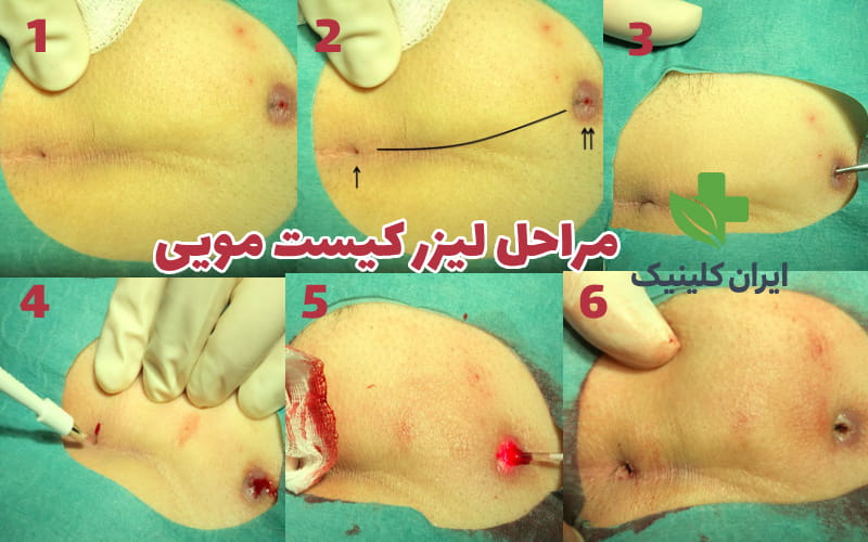 عکس مراحل انجام لیزر کیست مویی